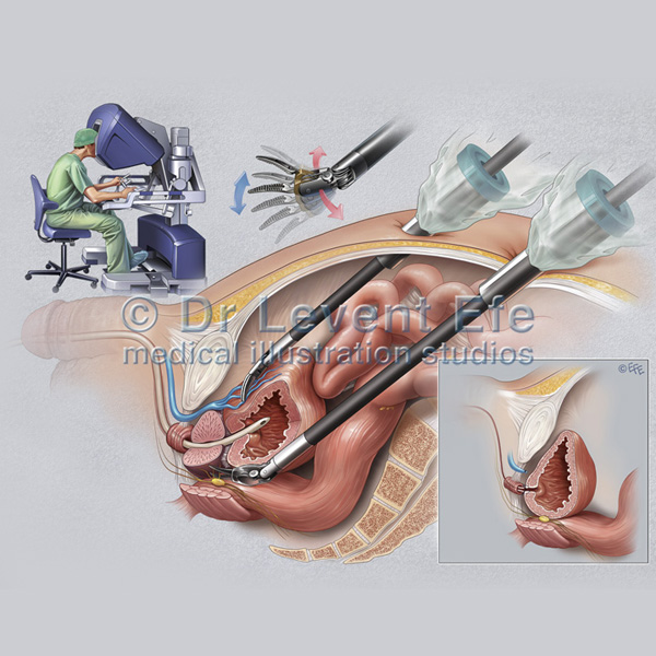 Medical Illustration: Robotic Surgery of the Prostate, Surgical Art, Surgical Illustrations | Efe's Medical Art Store: Medical Illustrations and Surgical