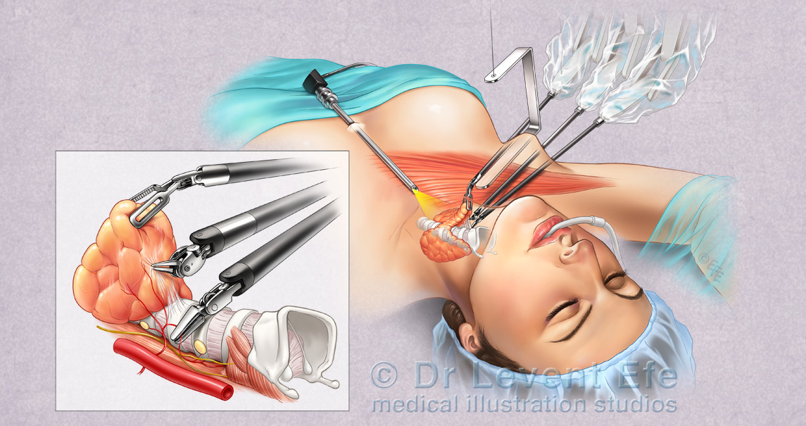Transaxillary robotic thyroid surgery