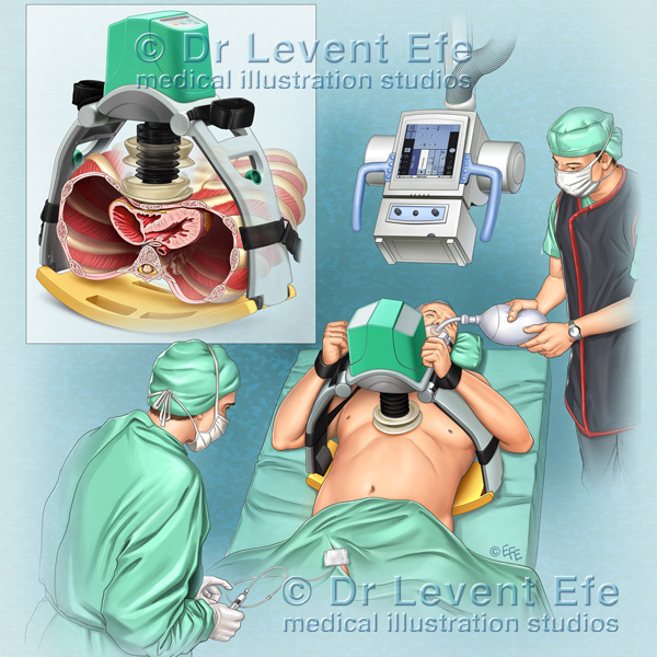 https://www.medicalartbank.com/wp-content/uploads/2013/12/LUCAS_Chest_Compression_medical_illustration.jpg